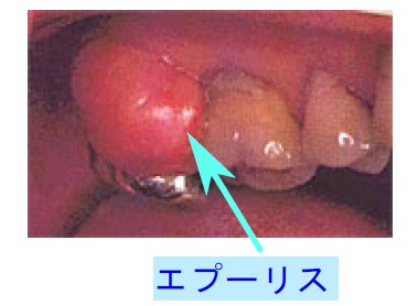 妊娠性エプーリス
