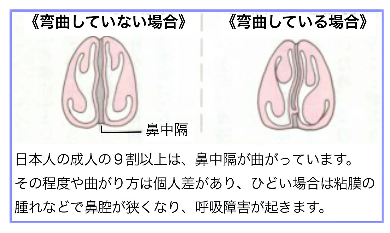 湾曲