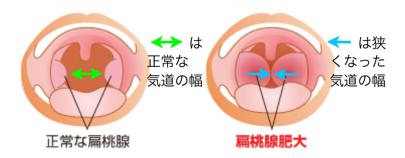 湾曲