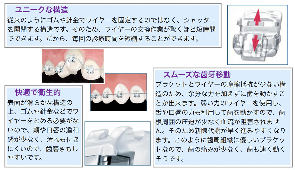 DAMONブラケットの特徴