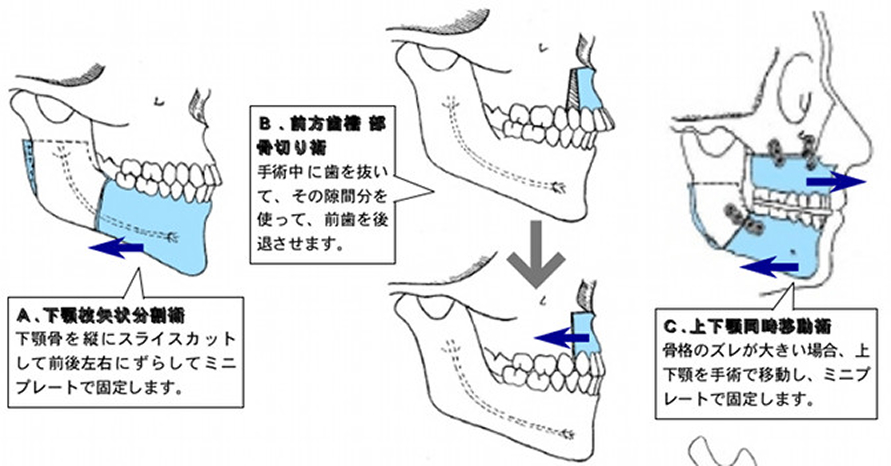 外科矯正の手術方法の模式図