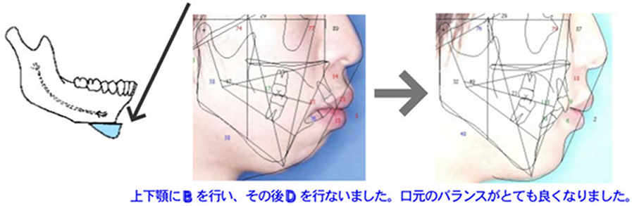 外科矯正の術前後比較