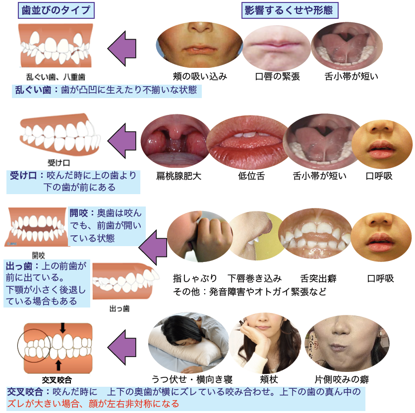 くせ 習癖 と歯並びの関係 横浜市の矯正専門歯科 福増矯正歯科
